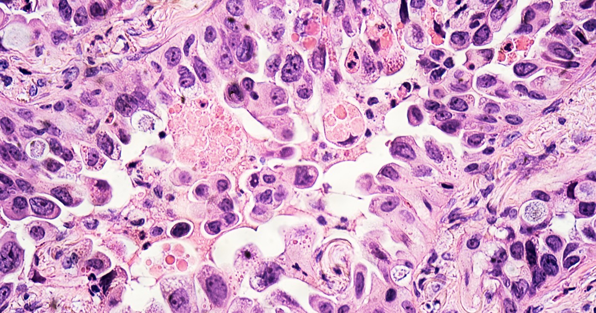 Lung Biopsy