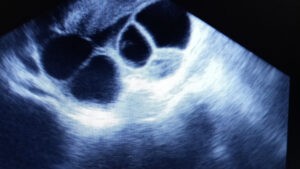 Pearl By Lynn Thayer